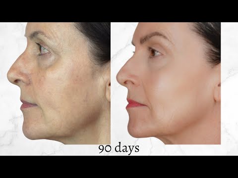 Видео: Обнаружение предраковых клеток актинического кератоза с помощью фотодинамической терапии синим св...