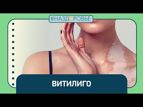 Видео: #НАЗДОРОВЬЕ: витилиго