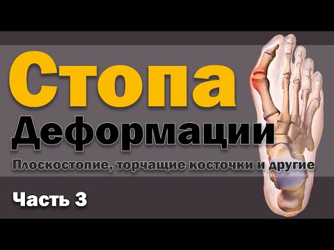 Видео: Стопа - Часть 3 - Деформации [S05E25]