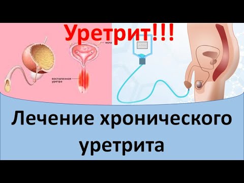 Видео: Лечение хронического уретрита