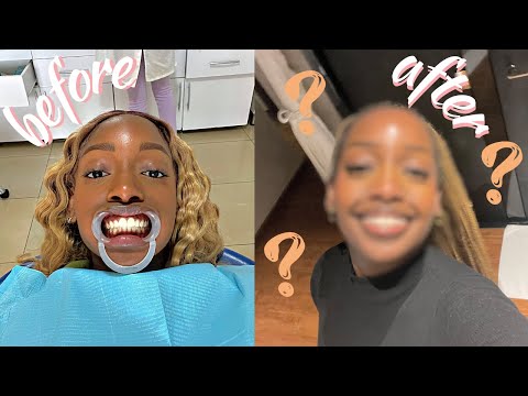 Видео: VLOG | СТАВЛЮ БРЕКЕТЫ!! и делаю всё, чтобы потом чувствовать себя милой | cheymuv