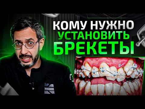 Видео: Установка брекетов в клинике Олега Конникова. Как это происходит?