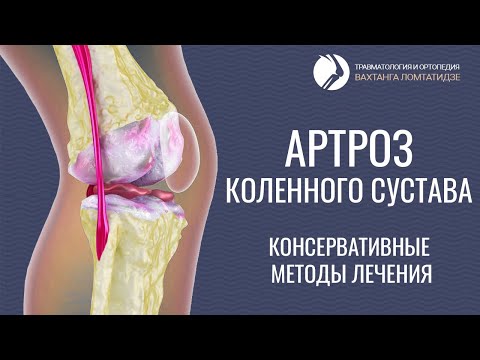 Видео: Артроз коленного сустава. Консервативные методы лечения