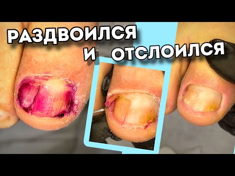 Видео: Ноготь дал трещину | прирастет если помазать красным