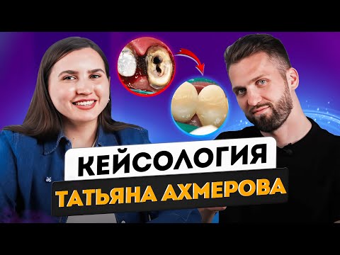 Видео: Татьяна Ахмерова -  Лечение зуба 4.7 | Протезирование на имплантате | Diagnocat | Работа с ИИ