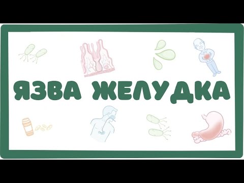 Видео: Язвенная болезнь желудка - причины, симптомы (лекция) Osmosis