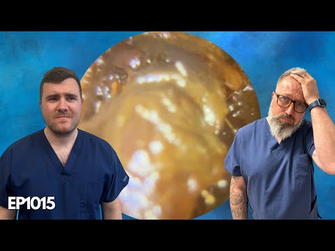 Видео: Ушная сера удалена после 4-й попытки - EP1015