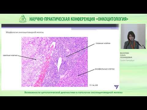 Видео: Возможности цитологической диагностики в патологии околощитовидной железы