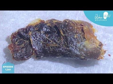 Видео: 1,261 - Удаление большого количества ушной серы и омертвевших кожных пробок