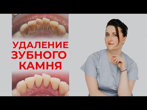 Видео: Как удалить зубной камень? / Профессиональная гигиена полости рта