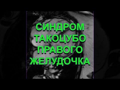 Видео: Синдром Такоцубо правого желудочка