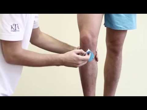 Видео: Кинезиотейпирование передней крестообразной связки
