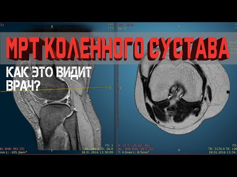 Видео: Разбор МРТ Коленного сустава. Что можно найти на снимке?