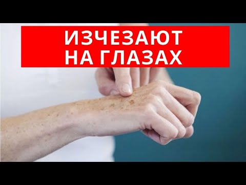 Видео: ДЕШЕВОЕ сильнодействующее СРЕДСТВО от ПИГМЕНТНЫХ ПЯТЕН