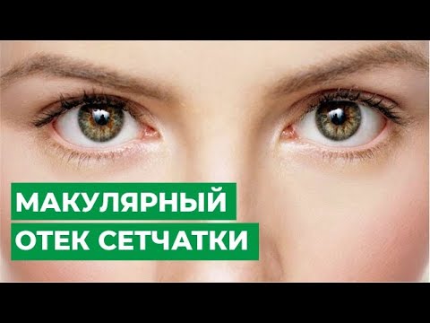 Видео: Лечение макулярного отека сетчатки.