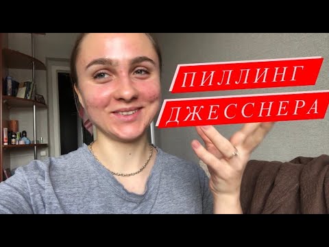 Видео: ПИЛЛИНГ ДЖЕССНЕРА. Процесс по дням. Мой опыт