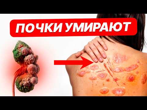 Видео: Сделай ЭТО с почками, пока не ПОЗДНО! Эти 5 признаков КРИЧАТ о проблемах с почками!