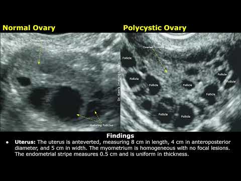 Видео: Пример заключения УЗИ при синдроме поликистозных яичников (СПКЯ) | Как составить заключение гинек...