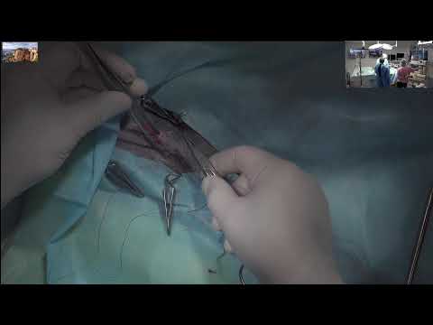 Видео: выпадение прямой кишки