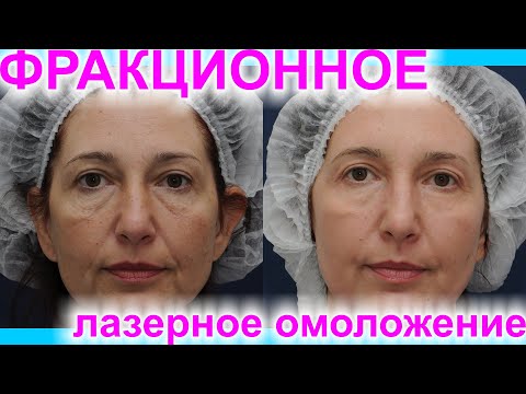 Видео: Фракционная лазерная шлифовка лица. Развенчиваем мифы. Комментарии пациентки. Результат До/После! #3