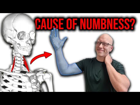 Видео: Эта маленькая мышца вызывает онемение рук и боль в шее. Расслабьте её!