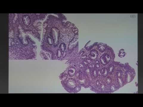 Видео: 05 Калинин ДВ   Морфологическая верификация Пищевода Барретта