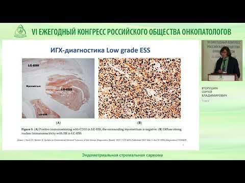 Видео: Эндометриальная стромальная саркома