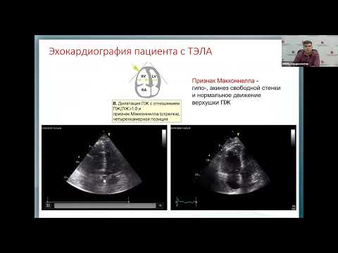 Видео: Тромбоэмболия легочной артерии Зюряев И.Т.