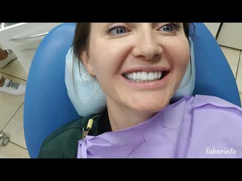 Видео: ВИНИРЫ через 5 лет. Теперь КРУПНЕЕ резцы! Как выбрать ЦВЕТ зубов