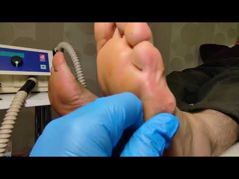 Видео: Омозолелости. Работа в скальпельной технике