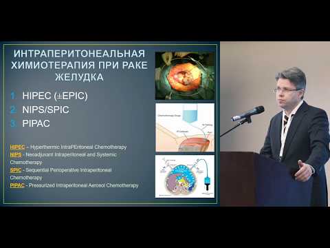 Видео: Изолированный перитонеальный канцероматоз: интраперитонеальная химиотерапия. ЗА