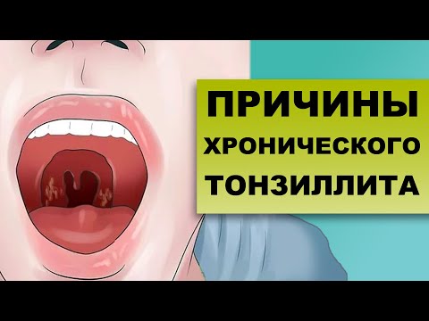 Видео: ПРИЧИНЫ ХРОНИЧЕСКОГО ТОНЗИЛЛИТА