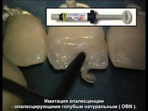 Видео: Реставрация передних зубов Др.Ванини
