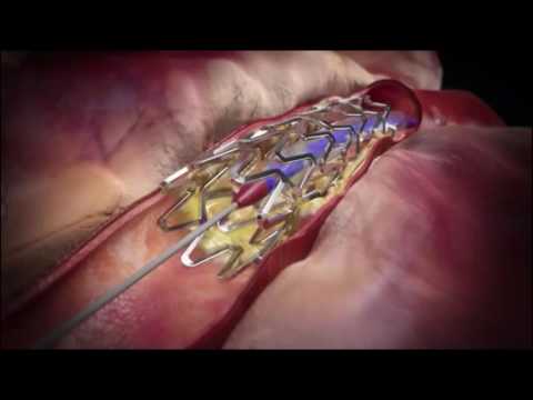 Видео: Инфаркт миокарда: Стентирование