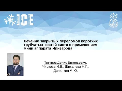 Видео: Лечение закрытых переломов коротких трубчатых костей кисти  с применением мини аппарата Илизарова