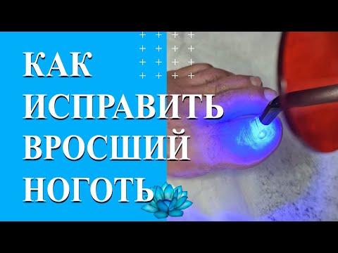 Видео: Лечение ногтей на ногах. Реальное удаление вросшего ногтя.