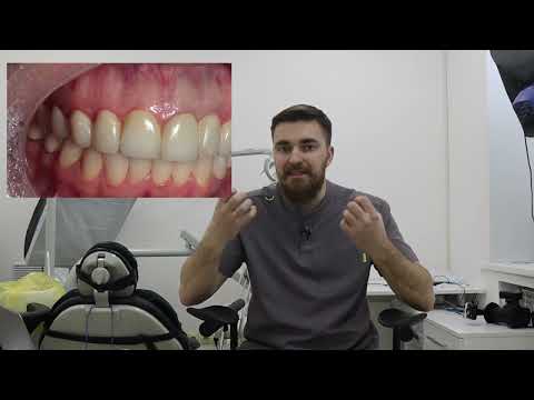 Видео: Кровит ДЕСНА? Есть решение!