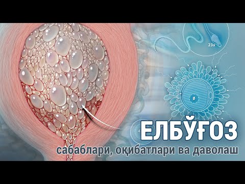 Видео: Елбўғоз. Сабаблари, оқибатлари ва даволаш