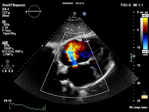 Видео: Врожденный порок сердца. ЭХОКГ в Уссурийске.