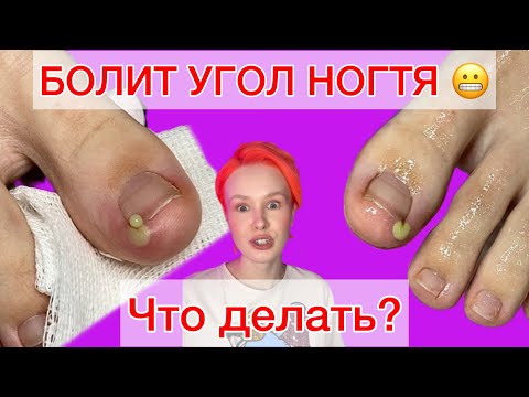 Видео: ВРОС НОГОТЬ | ЧТО ДЕЛАТЬ? | БОЛИТ УГОЛОК | ВРОСШИЙ НОГОТЬ НА НОГЕ #алена_лаврентьева #ногти