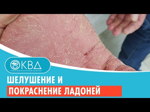 Видео: ✋ Шелушение и покраснение ладоней. Клинический случай №917