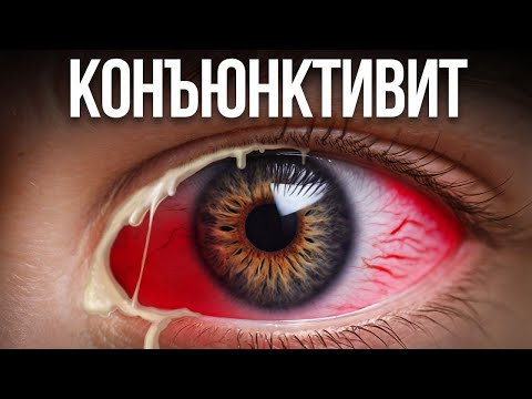Видео: Красные глаза, конъюнктивит лечение!  Как вылечить КОНЪЮКТИВИТ за 1 день без медикаментов?
