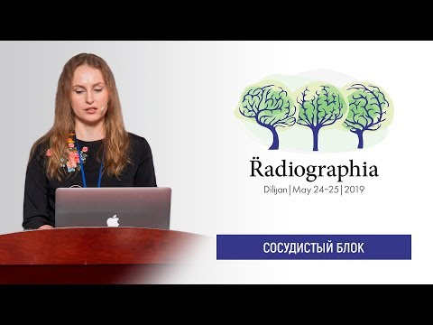 Видео: Марина Пекшева. Осложнения внутрисосудистых вмешательств при лечении ишемического инсульта.