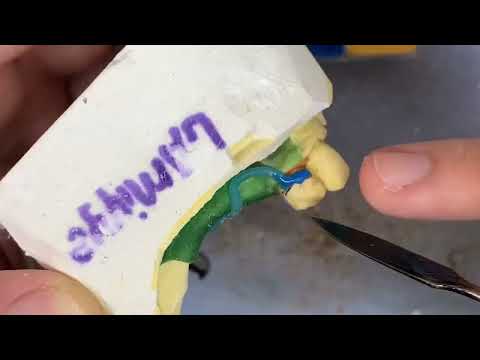 Видео: Metal clasp modelling for denture. Моделировка литьё кламмера для съёмного протеза. Одно из методов.
