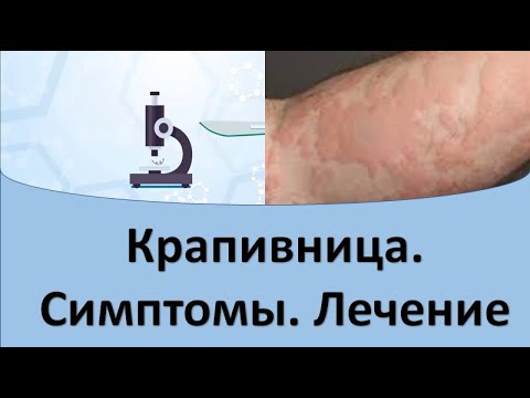 Видео: Крапивница. Причины. Симптомы. Лечение.