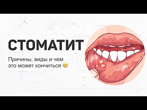 Видео: Стоматит. Какие бывают виды? С чем можно спутать? Когда пора бить тревогу?