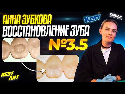 Видео: Восстановление зуба 3.5 | Реставрация второго премоляра | Анна Зубкова - RestART