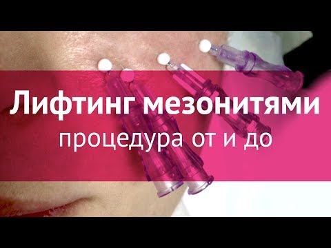 Видео: Подтяжка лица мезонитями: процедура от и до