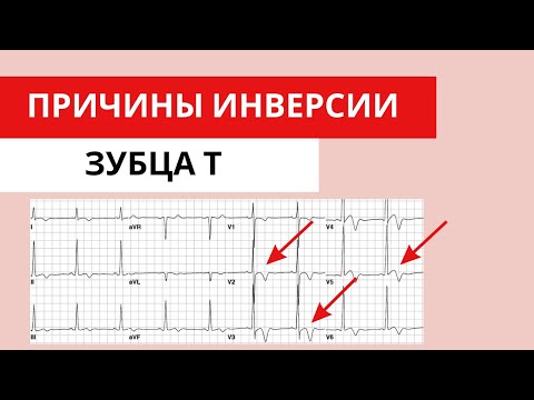 Видео: Инверсия зубца Т. Ишемия миокарда и другие причины. Нарушение процессов реполяризации.