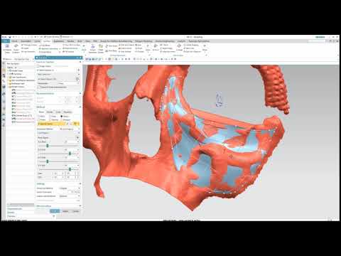 Видео: Как создать лицевой имплантат инструментами реинжиниринга в NX. Ver. 1.0  | Medical engineering NX